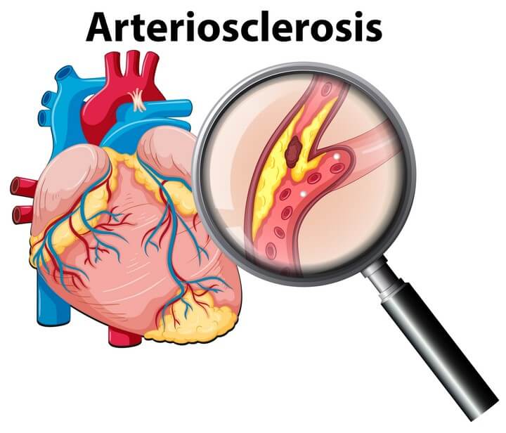 arterioscleroris
